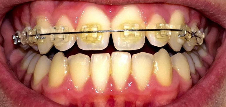 Tẩy trắng răng sau niềng răng và những điều cần lưu ý