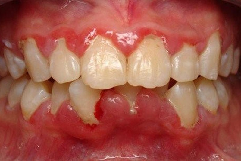 Bệnh viêm chân răng uống thuốc gì nhanh khỏi?