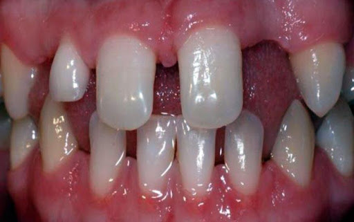 Trẻ mọc thiếu răng: Nguyên nhân và cách khắc phục