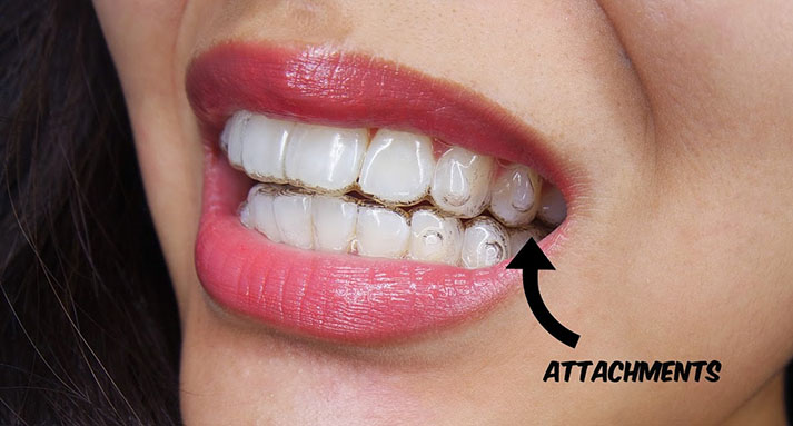 Tại sao phải gắn attachment khi niềng răng invisalign?