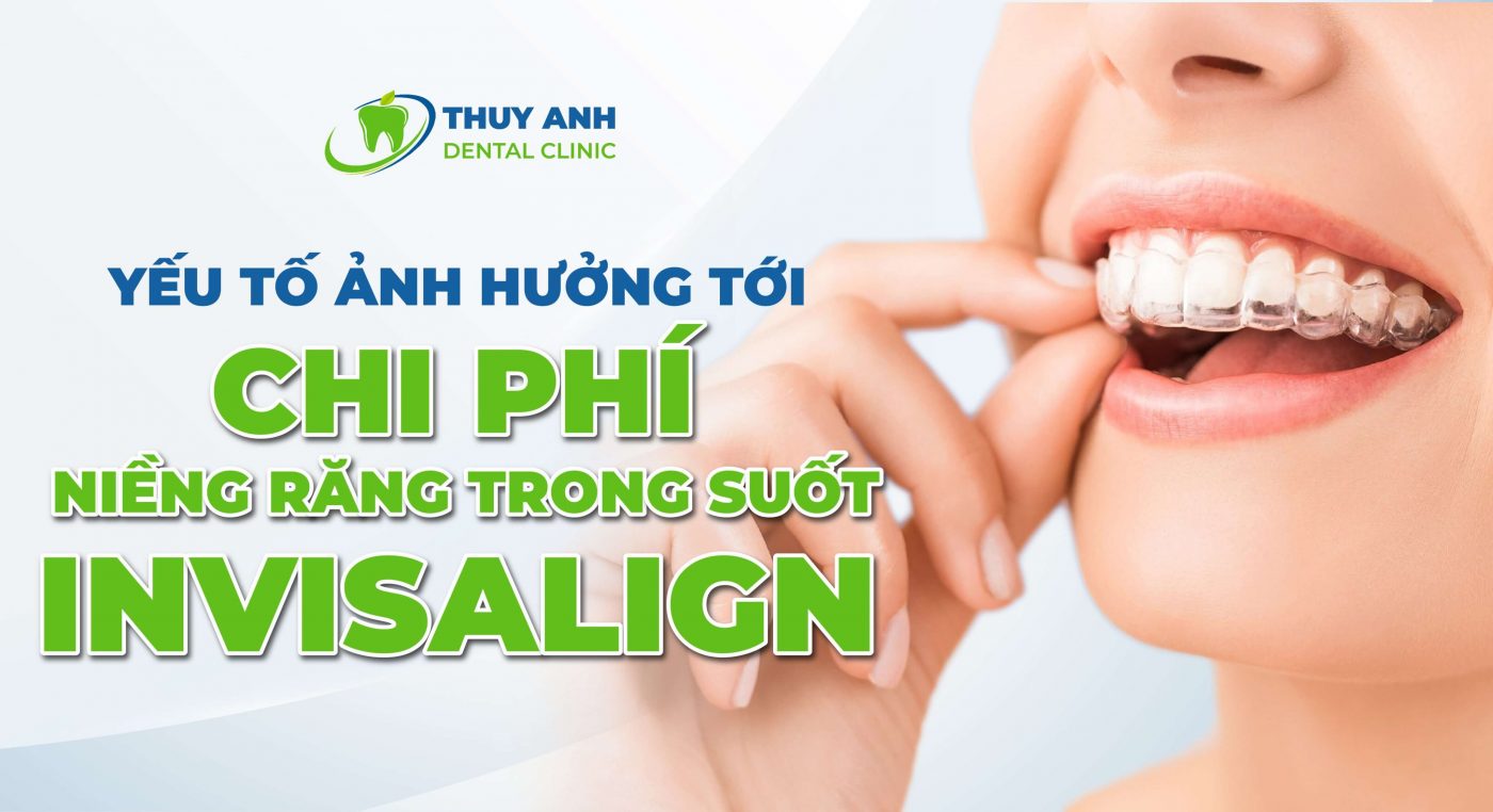 3 yếu tố tác động đến chi phí niềng răng trong suốt Invislaign