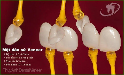 Tại sao sau dán sứ veneer răng dễ bị sâu răng? Nha khoa Thùy Anh