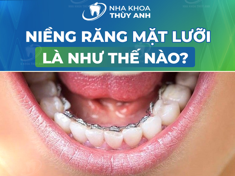 Niềng răng mặt lưỡi là gì? Có hiệu quả không? Chi phí bao nhiêu?