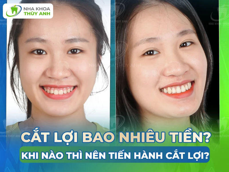 Cắt lợi bao nhiêu tiền? Khi nào thì nên tiến hành cắt lợi?