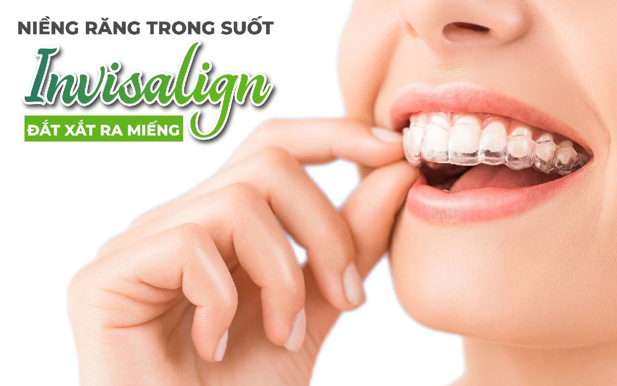 Niềng răng trong suốt Invisalign có tác dụng gì?