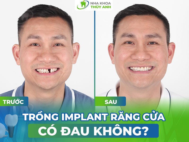 Trồng implant răng cửa có đau không? Thời gian mất bao lâu?