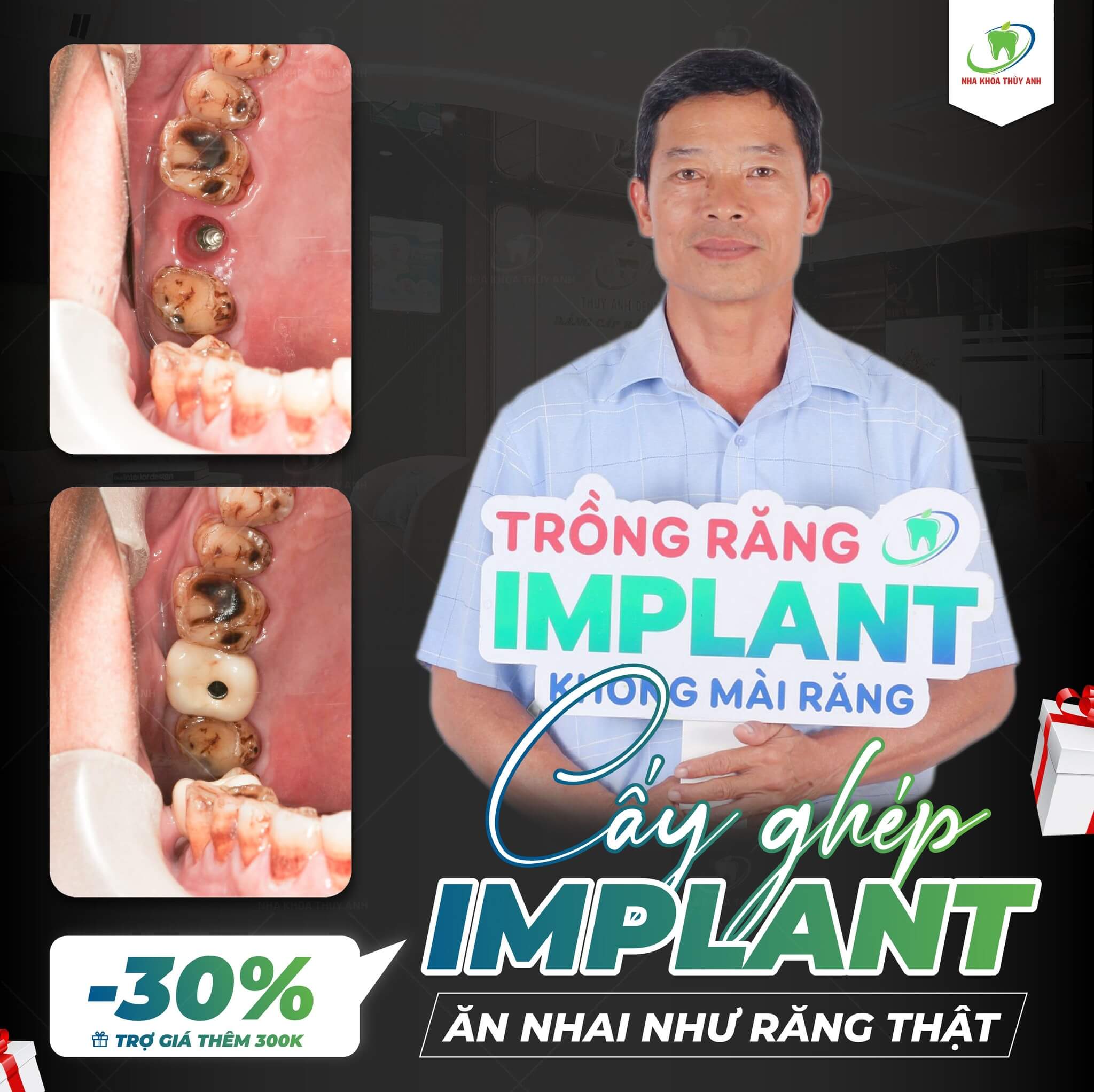 trong-rang-implant-gia-re-2 (1)