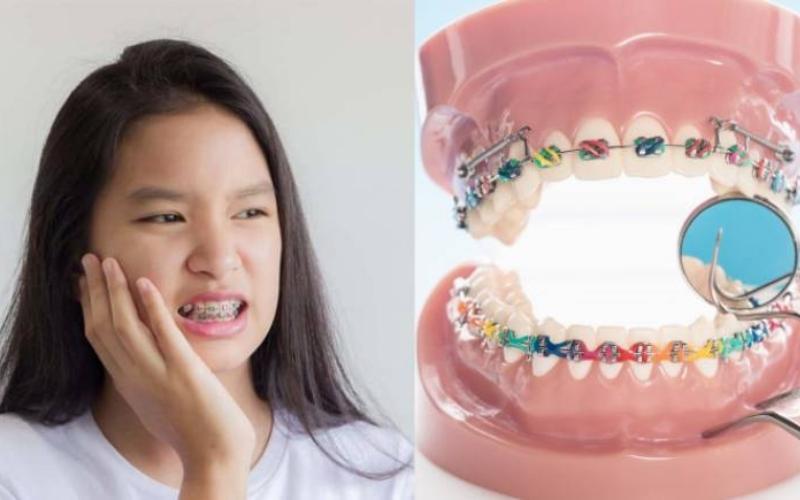 8 mẹo giảm ê răng khi niềng cực hiệu quả – nha khoa Thùy Anh