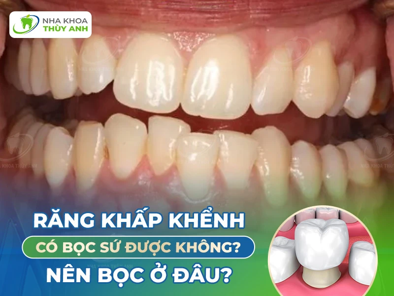 Răng khấp khểnh có bọc sứ được không? Nên bọc ở đâu?
