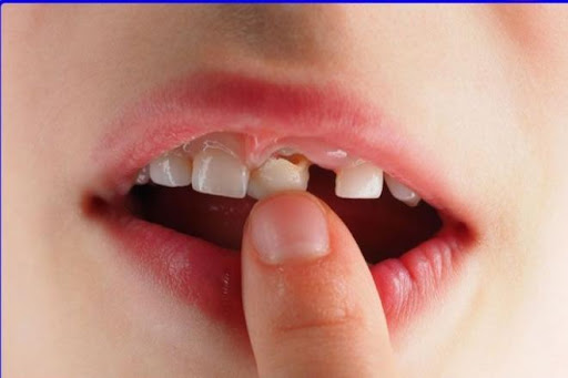 Những lưu ý về quá trình thay răng sữa của trẻ – nha khoa Thùy Anh
