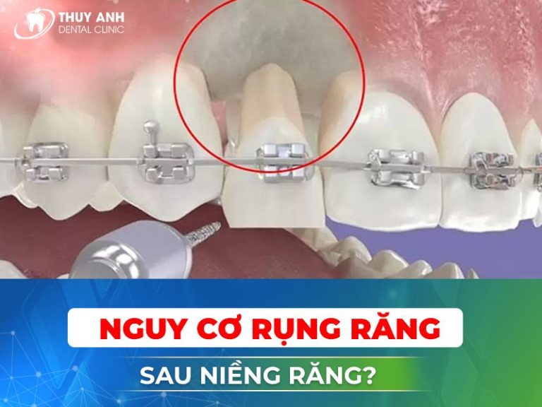 Lý giải nguyên nhân khiến răng bị rụng sớm khi niềng - nha khoa Thùy ...