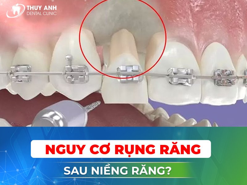 Lý giải nguyên nhân khiến răng bị rụng sớm khi niềng – nha khoa Thùy Anh