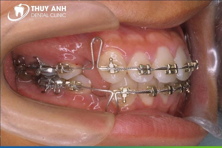 Niềng răng bẻ dây và không bẻ dây khác nhau thế nào? Có bắt buộc phải bẻ dây không?