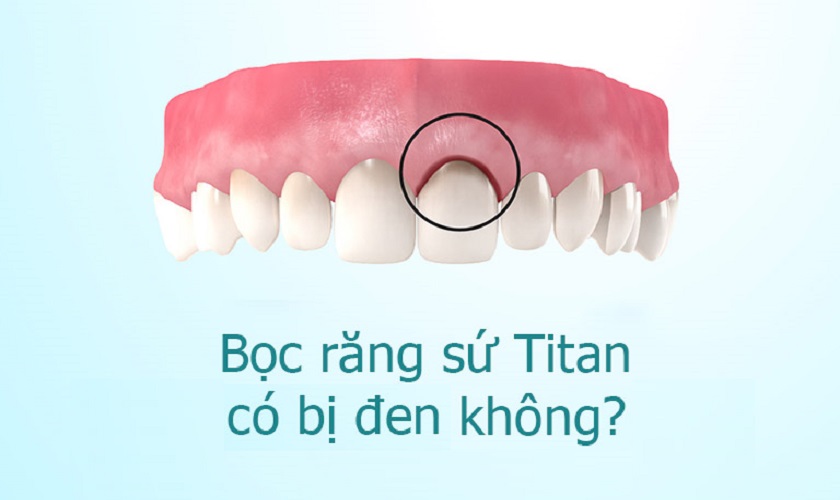 Răng sứ titan có bị đen không? Nha khoa Thùy Anh
