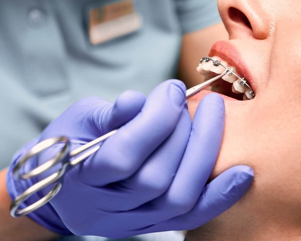 Những tai nạn có thể xảy khi niềng răng và hướng xử lý