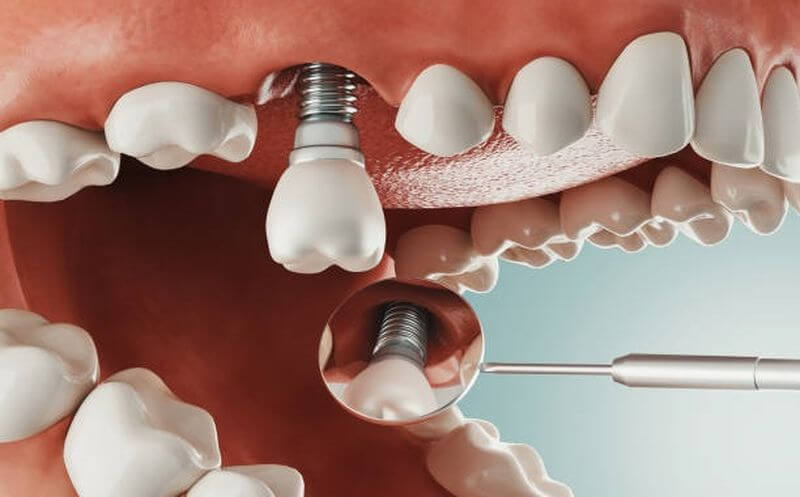 Tiêu chuẩn nha khoa trồng răng implant uy tín Cầu Giấy cần đạt được