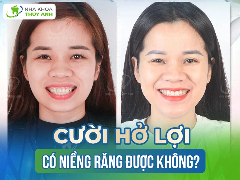 Cười hở lợi có niềng răng được không? Khắc phục cười hở lợi không phẫu thuật