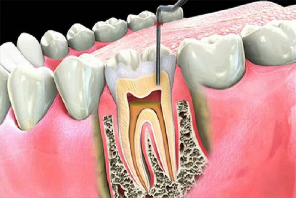 Điều trị tủy răng có đau không? Nha khoa Thùy Anh