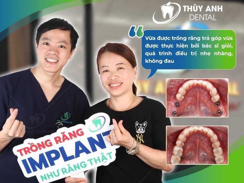 Bảng giá trồng răng implant - nhakhoathuyanh