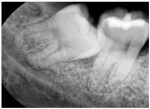 Coronectomy – Kỹ thuật nhổ răng khôn để lại phần chóp tránh tổn thương dây thần kinh
