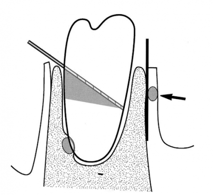 coronectomy-k-thu-t-nh-r-ng-kh-n-l-i-ph-n-ch-p-tr-nh-t-n-th-ng