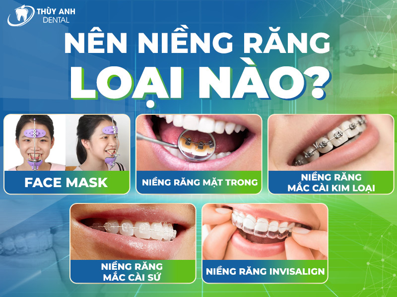 Hiện có những loại niềng răng nào phổ biến? Nha khoa Thùy Anh