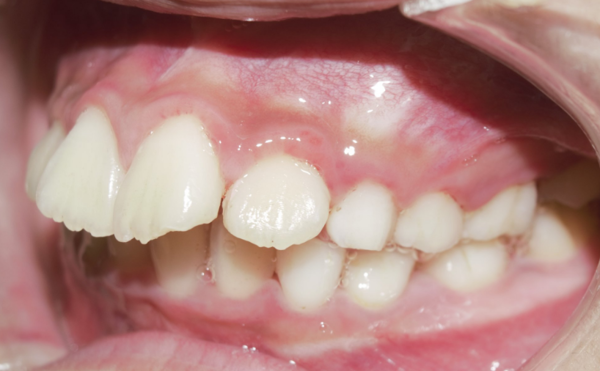 Niềng răng hô Cầu Giấy – khắc phục răng hô 1 lần hiệu quả mãi mãi