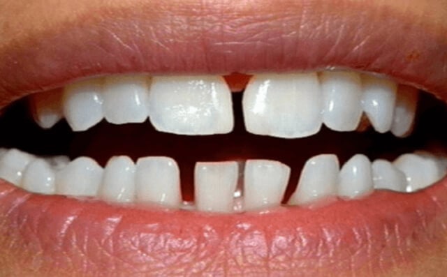 Niềng răng thưa Cầu Giấy giải pháp khắc phục răng thưa hiệu quả tối ưu
