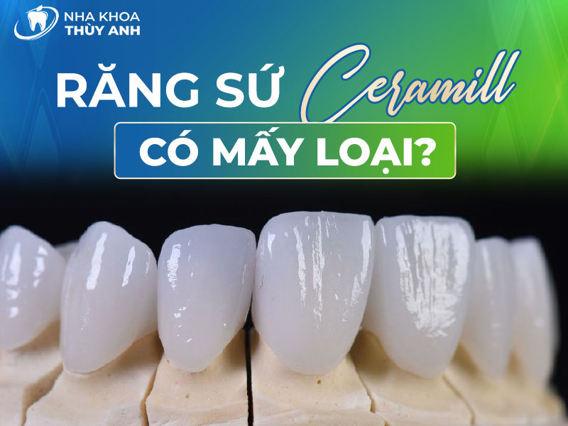 Răng sứ ceramill có mấy loại? Trường hợp nào có thể bọc sứ ceramill?
