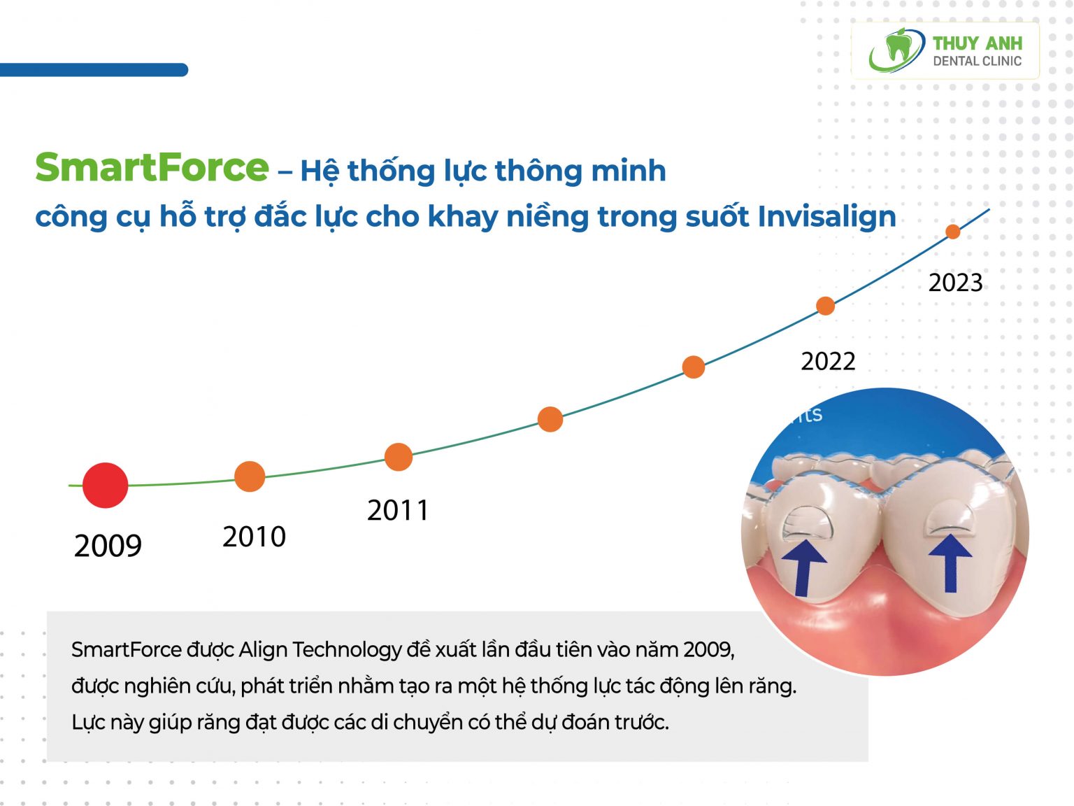 Niềng răng invisalign và những thông tin quan trọng bạn cần nắm rõ ...