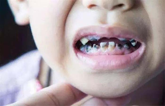 Bố mẹ nên làm gì khi trẻ bị sâu răng sữa? Nha khoa Thùy Anh ...