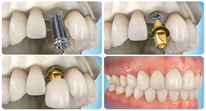 Trồng răng giả implant có tốt không? Trồng răng giả Cầu Giấy ở đâu uy tín?