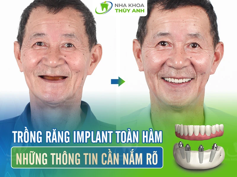 Trồng răng implant toàn hàm: Những thông tin cần nắm rõ
