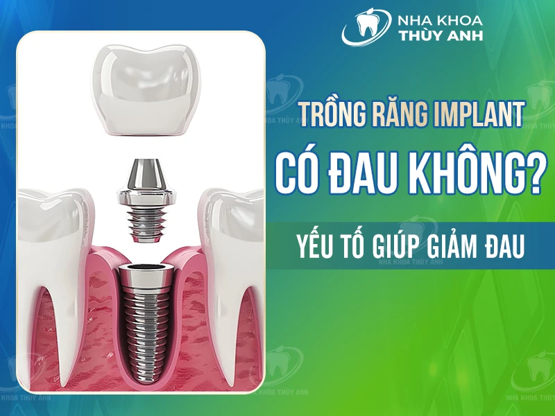 Trồng răng implant có đau không? Yếu tố giúp giảm đau