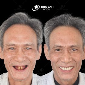 Chú Minh Tuấn - trồng răng all on 4 2 hàm