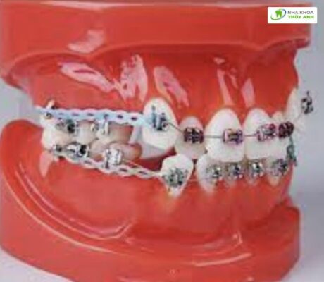 Tất tần tật về các loại chun trong chỉnh nha và hướng dẫn sử dụng - Bác ...