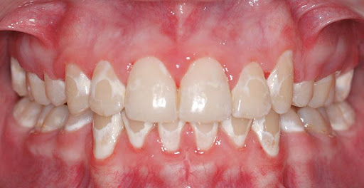 Cách loại bỏ đốm trắng sau niềng răng: Không veneer, không bọc sứ