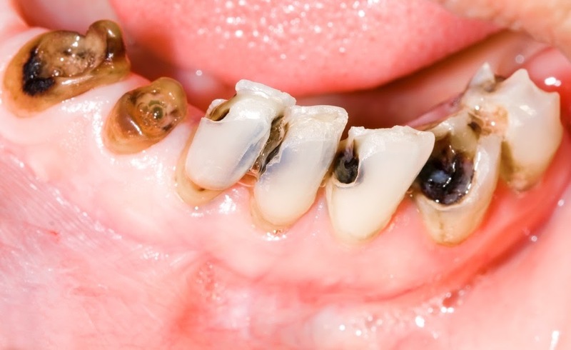 Nên nhổ răng sâu khi nào và thực hiện thế nào cho an toàn? Bác sĩ Huy