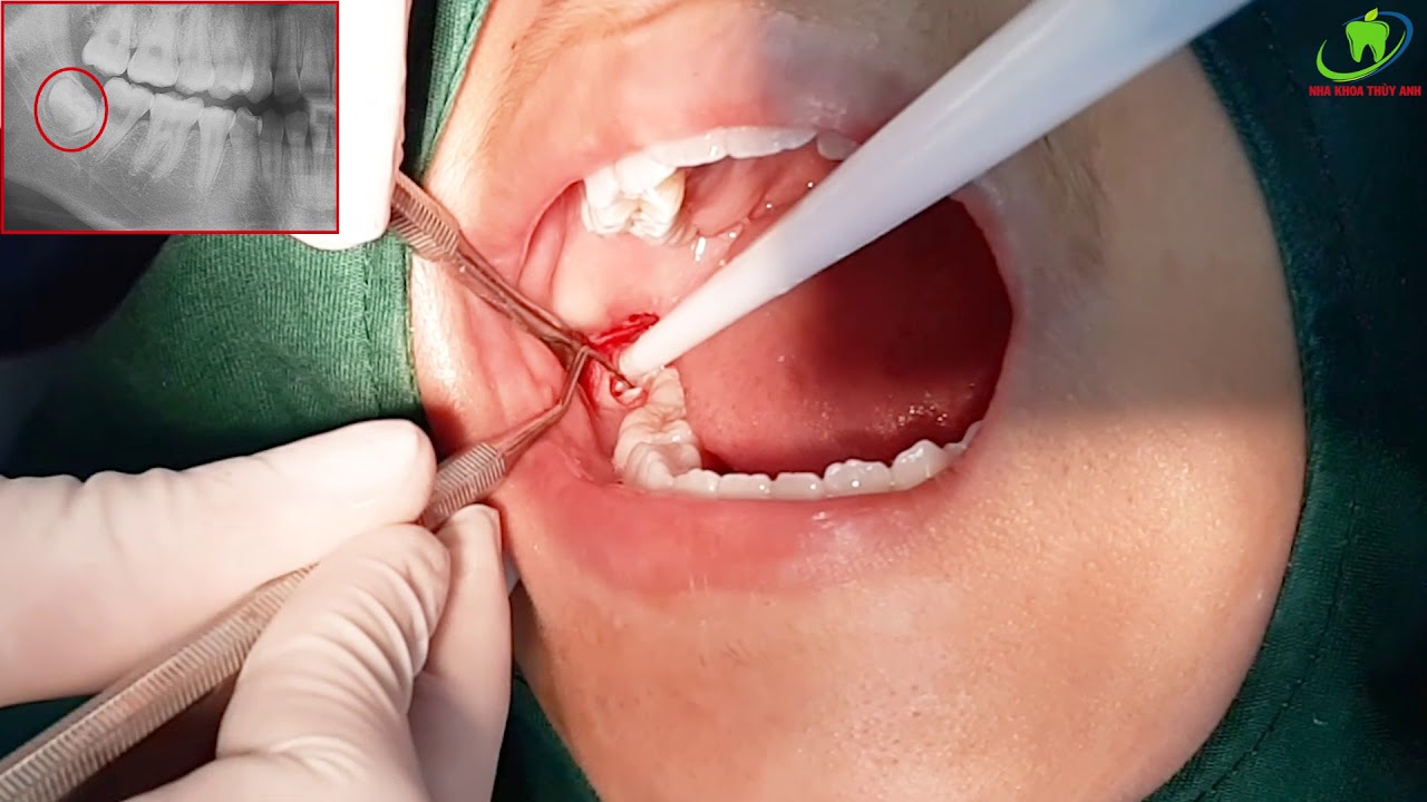Quy trình thực hiện nhổ răng khôn và số lần hẹn tái khám – Bác sĩ Chung