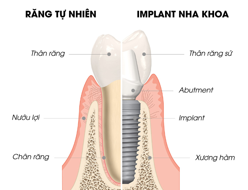 Chân răng Implant dùng bao nhiêu năm thì phải thay mới?