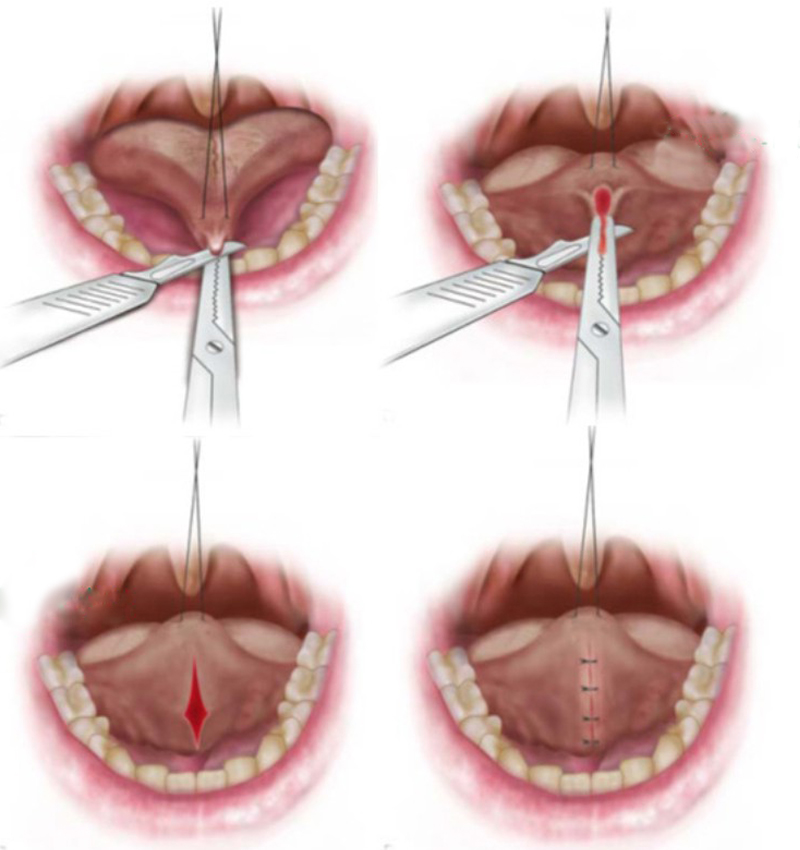 tat-dinh-luoi-8