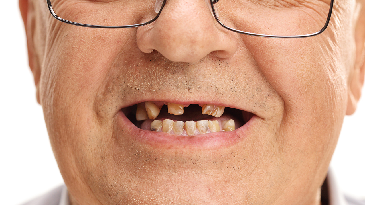 Các phương pháp trồng răng giả Bắc Giang? Nha khoa Thùy Anh
