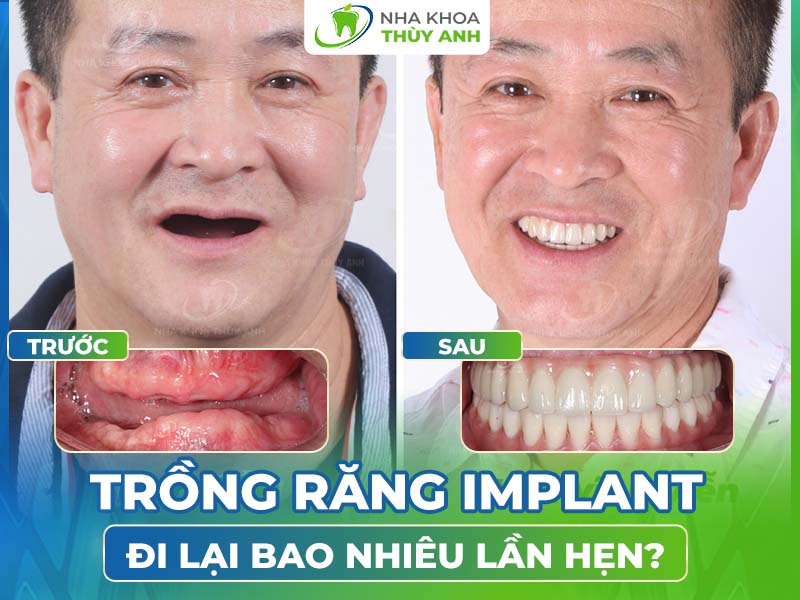 Trồng răng implant đi lại bao nhiêu lần hẹn? Nha khoa Thùy Anh