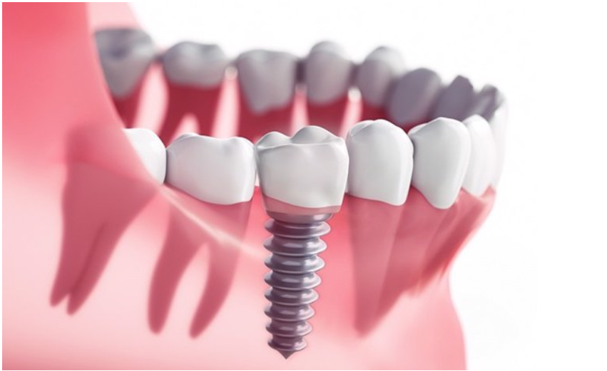 Địa chỉ trồng răng implant Bắc Giang uy tín chất lượng tiết kiệm chi phí