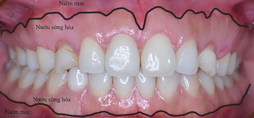 Ghép lợi sừng hóa trong trồng răng implant: Khi nào, tại sao và làm thế nào?