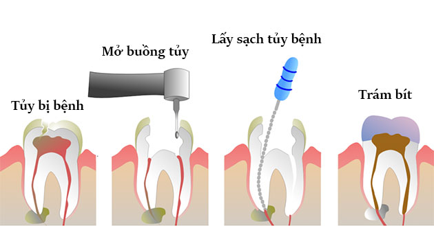 Sâu răng ăn vào tủy là tình trạng thế nào? Cách giảm đau hiệu quả