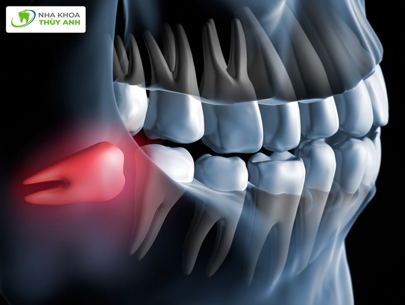 Răng ngầm có nguy hiểm không? Cách xử lý răng ngầm