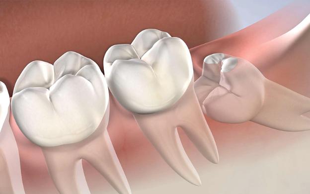Lược sử răng khôn: Dấu vết tiến hóa và những chỉ định nhổ bỏ đầu tiên – bác sĩ Hòa Bình