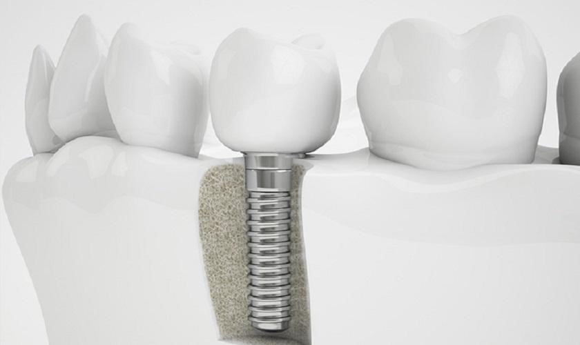 Ưu điểm của trồng răng implant là gì? Nha khoa Thùy Anh
