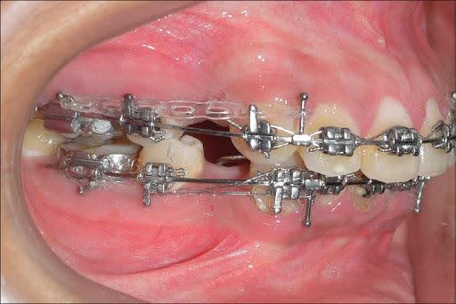 Di chuyển răng số 3 trong chỉnh nha – Bs Diễm nha khoa Thùy Anh